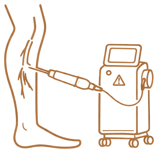 Endolaser para varizes em ambiente clínico