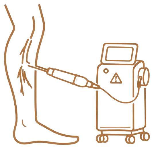 Endolaser para varizes em ambiente clínico