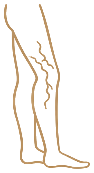 Ícone ilustrativo sobre varizes e sinais de alerta