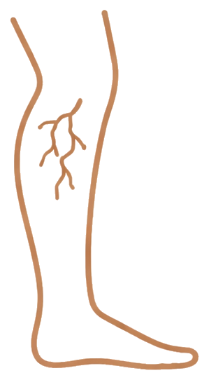 Ícone ilustrativo sobre vasinhos e desconforto nas pernas